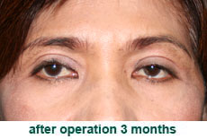 plastic-surgery-blepharoplasty